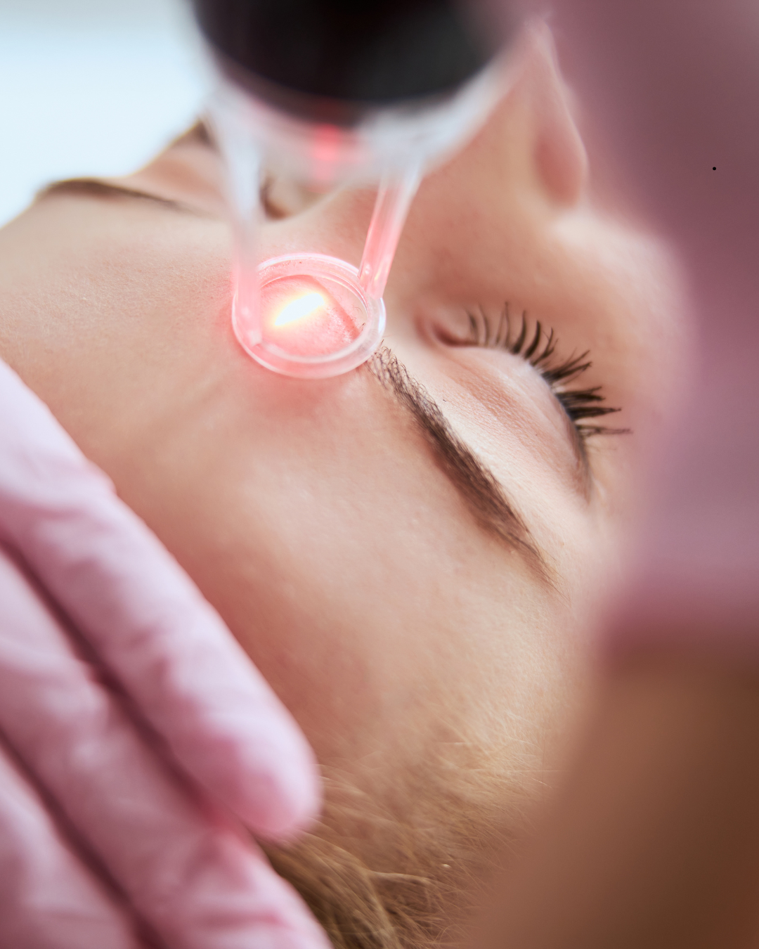 laser facials
